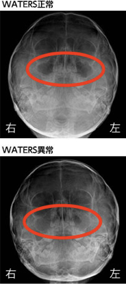 副 鼻腔 炎 治っ たか どうか